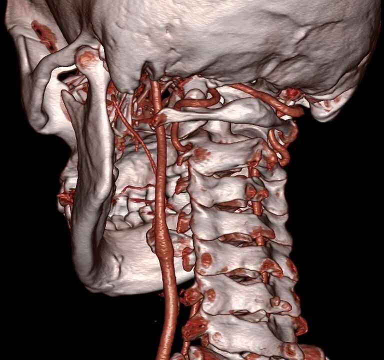 động mạch bị chèn ép với hoại tử xương cổ tử cung