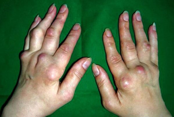 Bàn tay bị ảnh hưởng bởi biến dạng đa xương khớp