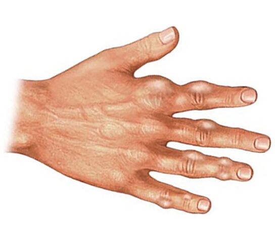 Lắng đọng các tinh thể axit uric trong các mô mềm của ngón tay bị viêm khớp do gút
